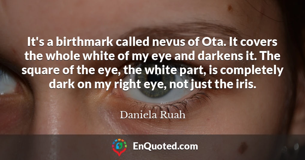 It's a birthmark called nevus of Ota. It covers the whole white of my eye and darkens it. The square of the eye, the white part, is completely dark on my right eye, not just the iris.